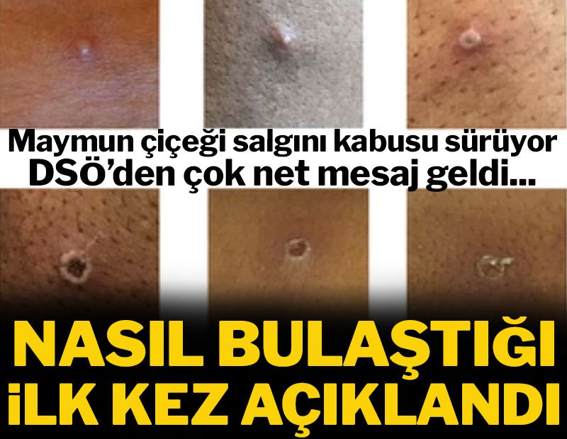 Dünya Sağlık Örgütü’nden maymun çiçeği hastalığı açıklaması: Aman dikkat! Nasıl bulaştığı açıklandı