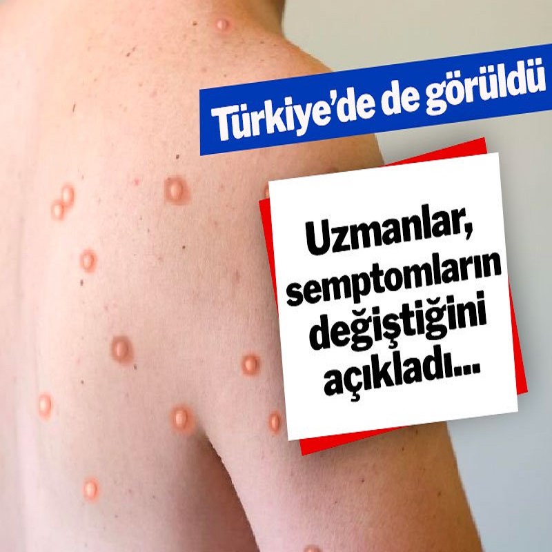 Türkiye’de de görülmüştü… Bilim insanları uyardı: Maymun çiçeği semptomlarında değişikler var. İşte o semptomlar!