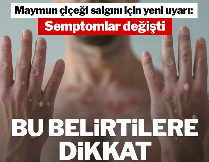 Maymun Çiçeği Salgını İçin Yeni Uyarı Yapıldı: Semptomlar Değişti. Bu Belirtilere Dikkat!