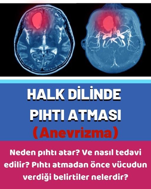 Neden pıhtı atar? Nasıl tedavi edilir?