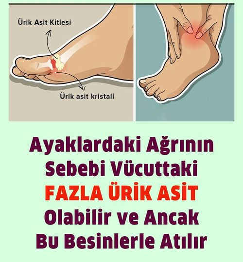 Ayaklarınızdaki ağrının sebebi vücudunuzdaki fazla ürik asit olabilir!