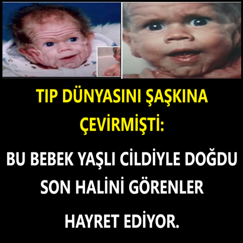 Tıp dünyasını şaşkına çevirmişti: Bu bebek yaşlı cildiyle doğdu son halini görenler hayret ediyor.