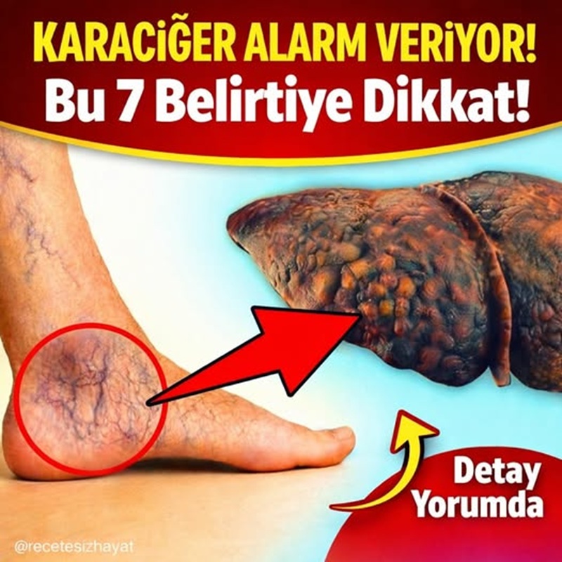 Bu 7 Belirtiyi Sakın Görmezden Gelme: Karaciğeriniz Alarm Veriyor Olabilir