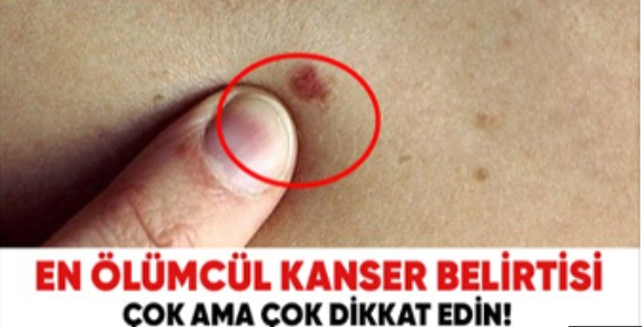 En ölümcül kanserin ilk belirtisi, sakın göz ardı etmeyin. Sizde de varsa hemen doktora gidin!