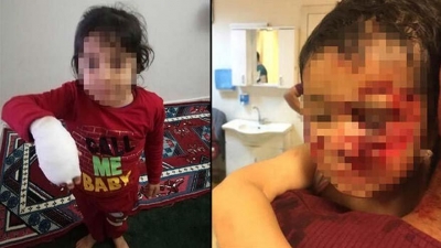 6 Çocuk Bu Hale Geldi 3'nün Durumu Ağır