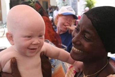 Afrika'da Lanetli Olduklarına İnanılan ve Uzuvları Kesilerek Yüksek Meblağlara Satılan Albinizmli Çocuklar!