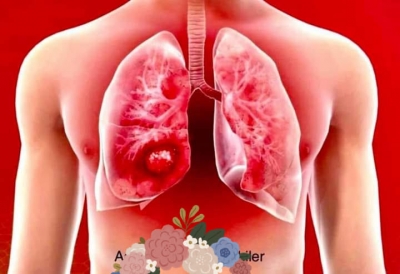 AKCİĞERİ TEMİZLEYEN ŞİFALI KARIŞIM. 