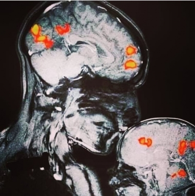 ALINDAN ÖPMEK VE EPİFİZ BEZİ MUCİZESİ