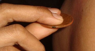 Bozuk Para İle Tedavi