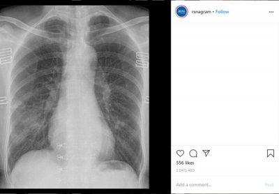 Corona Virüsle İlgili Korkunç Gerçek Ölen Hastanın Röntgeni Sayesinde Ortaya Çıktı