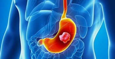 Dikkat! Eğer Bu Belirtilerden Birine Sahipseniz Sizde Mide Kanseri Olabilirsiniz