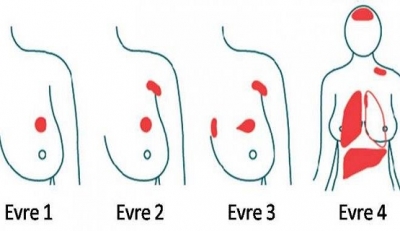 Göğüs Kanseri İçin Arnavut Göçmenlerinin uyguladığı bir yöntem