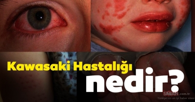 Hızla Çocuklara Yayılıyor. Bu Hastalık Virüsle mi Bağlantılı. Uzmanlar Açıkladı