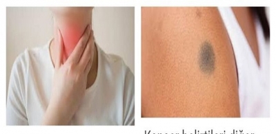 Kanserin 10 belirtisi 