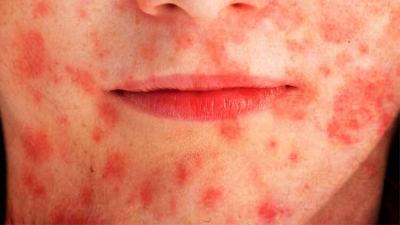 O Maskeler İçin Hayati Uyarı:Aman Dikkat!  Cildiniz Bu Hale Gelebilir 