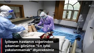 İyileşen korona hastasının akciğerinde bulunanlar şoke etti