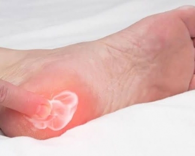 TOPUK DİKENİNE DOĞAL ÇÖZÜMLER