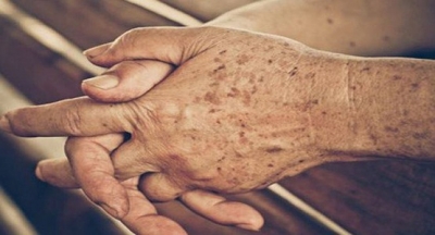 YAŞLILIK LEKELERİNE KARŞI DOĞAL KÜR TARİFİ