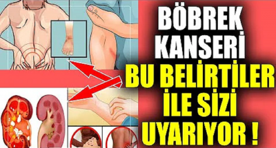 Böbrek Kanseri 9 Belirti İle Sizi Uyarır !