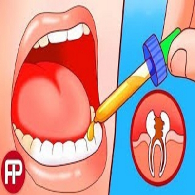 DİŞÇİYE GİTMEYİN! Diş Çürüklerini Ağrı Çekmeden Ortadan Kaldırın Sadece 5 ADIMDA