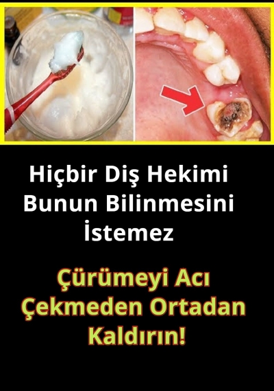 Hiçbir Diş Hekimi Bunun Bilinmesini İstemez - Çürümeyi Acı Çekmeden Ortadan Kaldırın!