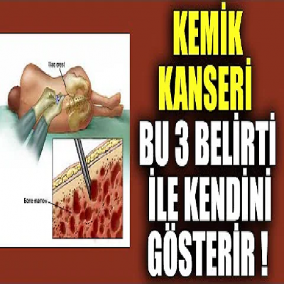 Kemik Kanseri Bu 3 Belirti İle Kendini Gösterir !